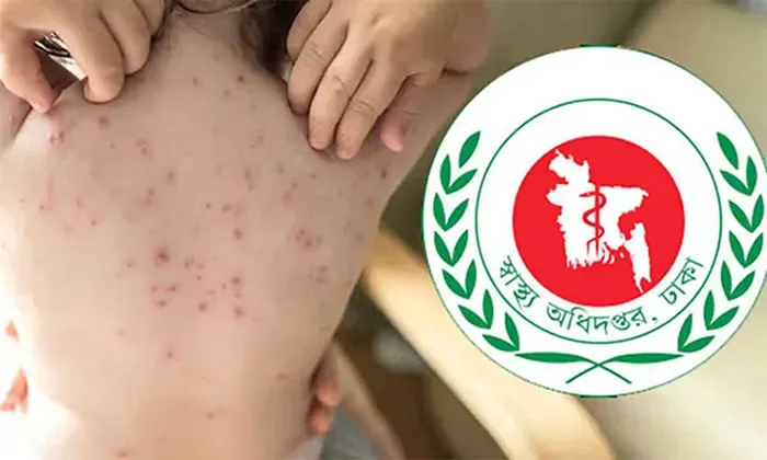 হাম ও উপসর্গে শিশু প্রাণহানি ৭০০ ছুঁই ছুঁই