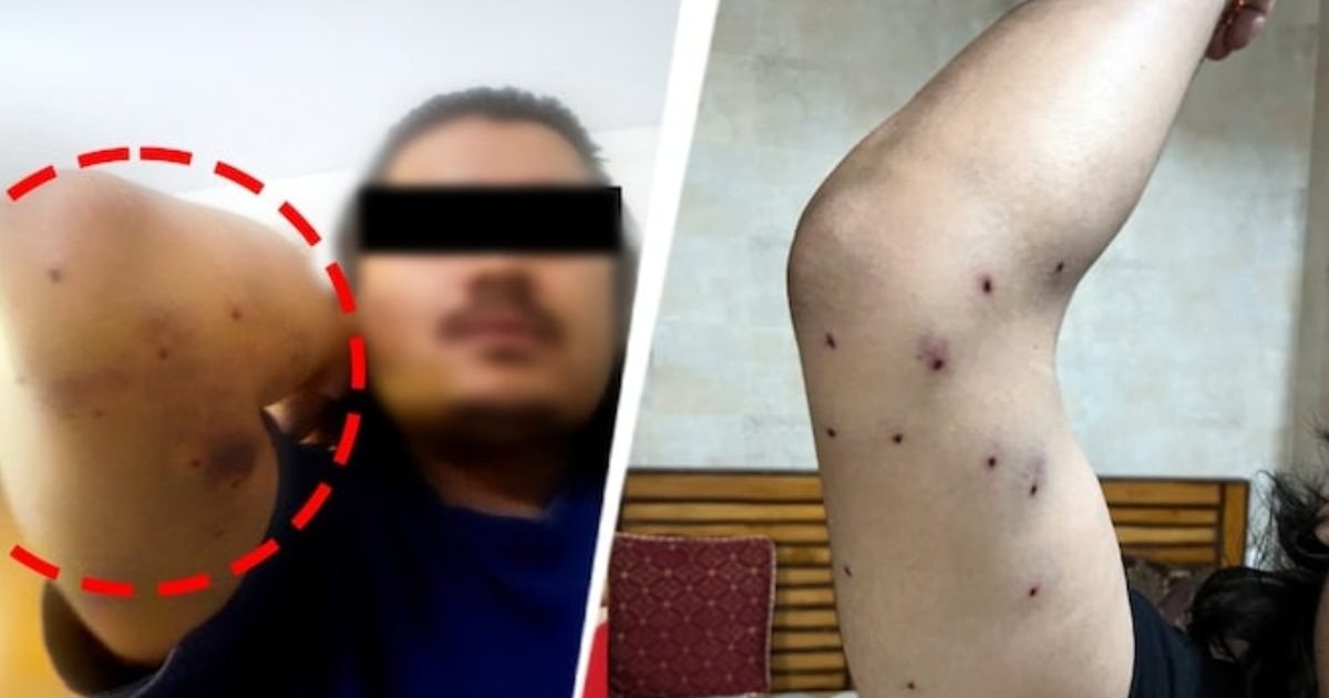 আন্দোলনকারীদের শরীরে পেলেটের আঘাতের প্রমাণ, পুলিশের দাবি অস্বীকার